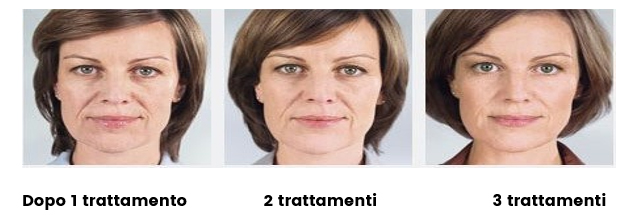 biostimolazione con acido polilattico: effetti dopo uno, due e tre trattamenti